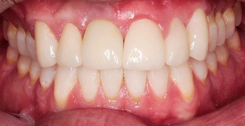 dental implants burke