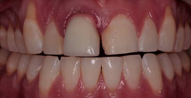 dental implants burke