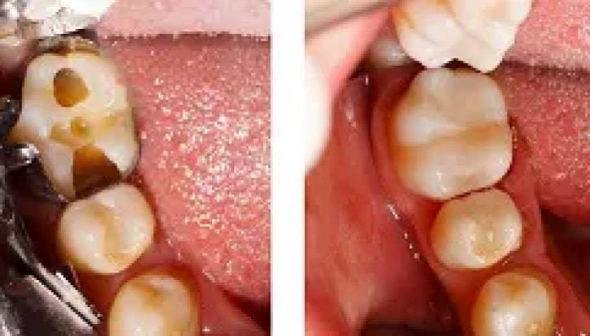 dental care burke va