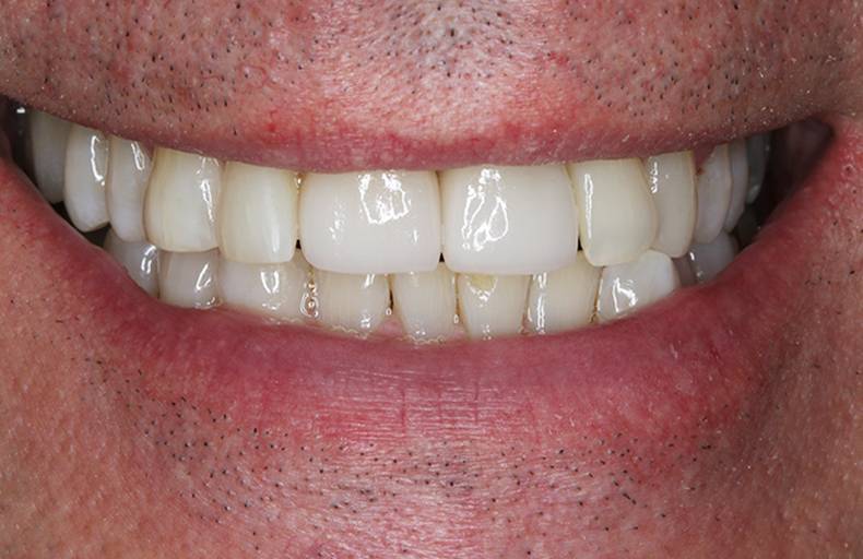 dental implants burke