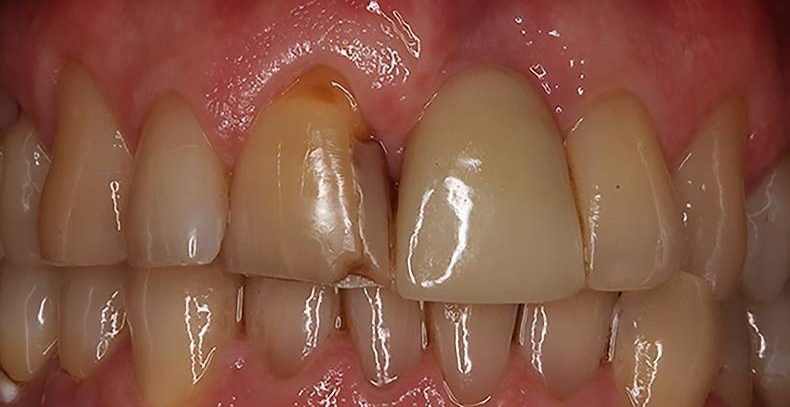 dental implants burke